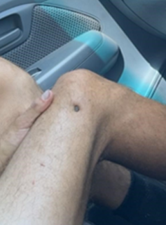 Image showing a nail projecting through a workers leg following an incident with a nail gun.
