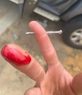 Image showing a nail projecting through a workers finger following an incident with a nail gun.